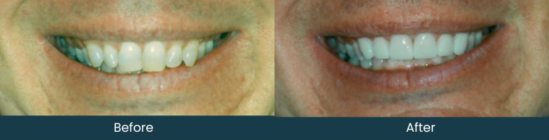 Before - 4