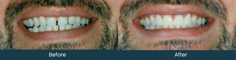 Before - 5